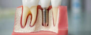 Импланта­ция зубов