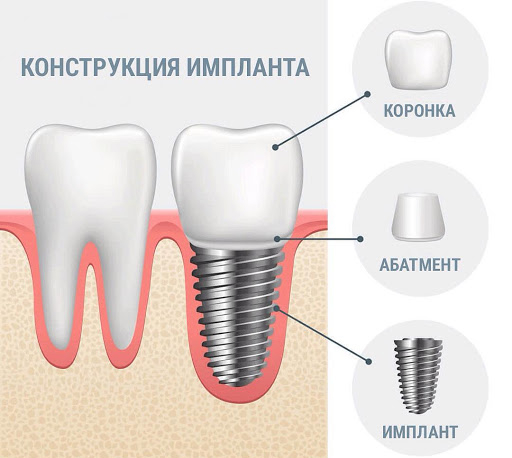 implant image